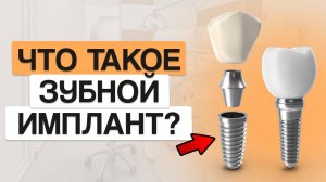 НУЖНО ЛИ УСТАНАВЛИВАТЬ ЗУБНЫЕ ИМПЛАНТЫ? ВСЯ ПРАВДА!