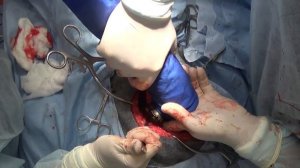 Хирургическое лечение гемангиоперицитомы подвздошной кости с инвазией в крестец