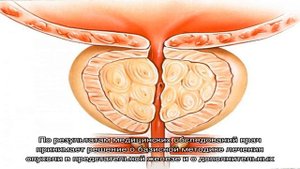 Особенности метастазирования в костях при раке простаты