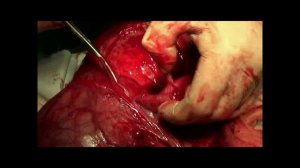 Новообразование мочевого пузыря