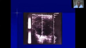 Перитонит  острый диффузный