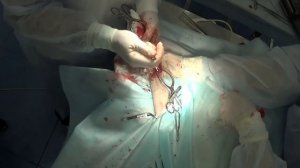 Артродез запястных сустававов