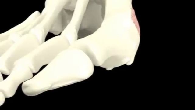 Hallux Valgus 3D