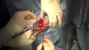 Транспозиция гребня большеберцовой кости