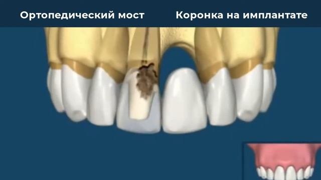 Ортопедический мост или коронка на имплантате