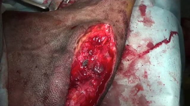 Хирургическая техника удаления блокированной пластины и сорванных винтов