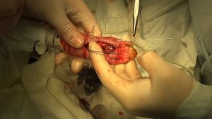 Перелом пястных костей