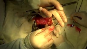 Дивертикул прямой кишки + промежностная грыжа