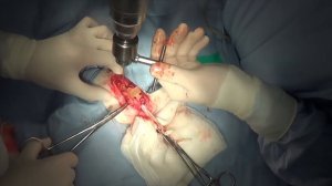 Хирургическое лечение ложного сустава плечевой кости