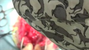 Хирургическое лечение повреждения транспедикулярного фиксатора у собаки