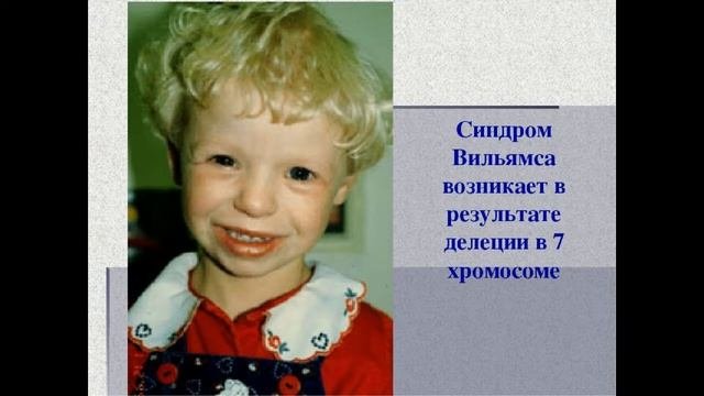 Синдром Вильямса. Синдром Уильямса (синдром «лица эльфа»)