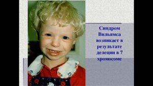 Синдром Вильямса. Синдром Уильямса (синдром «лица эльфа»)