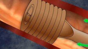 Клапанная бронхоблокация