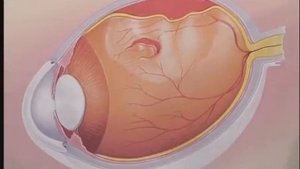 Невидимая угроза. Как обнаружить отслоение сетчатки и спасти зрение