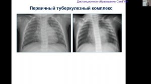 Туберкулез легких у детей. Лектор Ю.С. Пышкина
