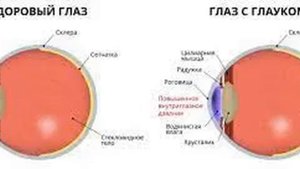 Психосоматика плохого зрения: Глаукома
