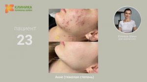 23. Акне на щеках тяжелая степень (до и после)