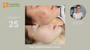25. Акне среднетяжёлая степень (до и после)