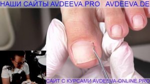 ПЕДИКЮР.ПОДНОГТЕВЫЕ МОЗОЛИ. Виктория Авдеева