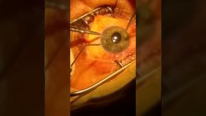 Пластика радужки. ОКЛ г.Черновцы