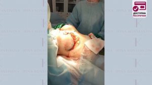 Редукционная маммопластика L-рубец. Пластический хирург Константинова И.В.
