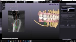 Расстановка имплантатов Avantis 3D
