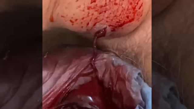 Хиджама. Капиллярное кровопускание. Кровопускание. Вакуумное лечение.  боль спины. лечить спину