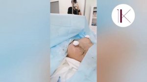 Результат подтяжки груди без имплантов: Как выглядит грудь сразу после операции?