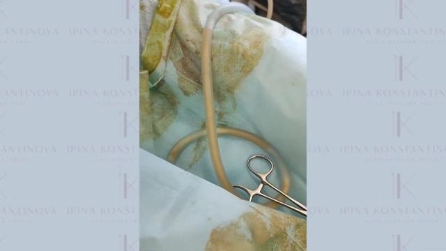 Проведение липосакции - как проходит операция? Съемка с операционного стола