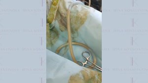 Проведение липосакции - как проходит операция? Съемка с операционного стола