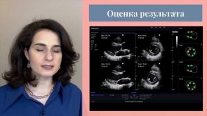 Стресс ЭХО-кардиография в диагностике ИБС. Читает к.м.н. Григорян Марина, врач-кардиолог