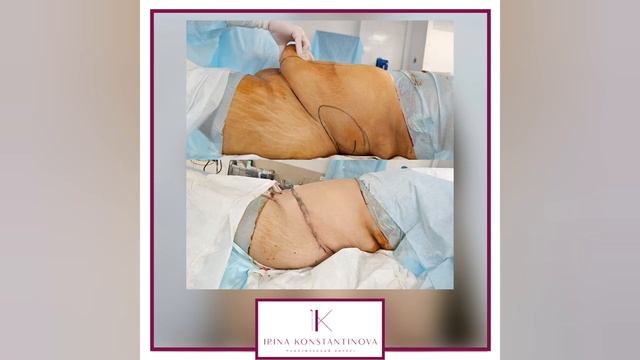 Абдоминопластика - результат пластики живота с операционного стола