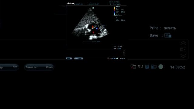 Дефект межпредсердной перегородки. ООО смотреть онлайн