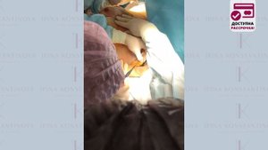 Удаление добавочных долек молочных желез. Сьемка с операционного стола