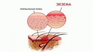 ⚡ ПСИХОСОМАТИКА - ЭКЗЕМА! В чем конфликт❔