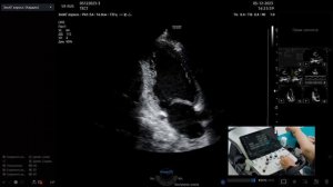 Обзор возможностей УЗИ сканера Samsung V8 при проведении трансторакальной эхокардиографии