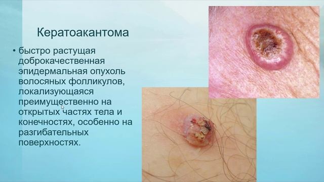 Тема 05. Беспигментные новообразования