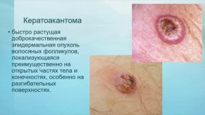 Тема 05. Беспигментные новообразования