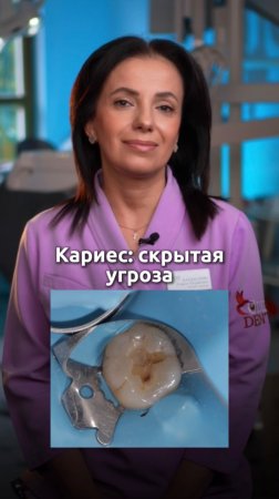 Кариес: скрытая угроза 

#colibridental #colibridentalclinic #лечениезубов #кариес #эндодонтия #плом