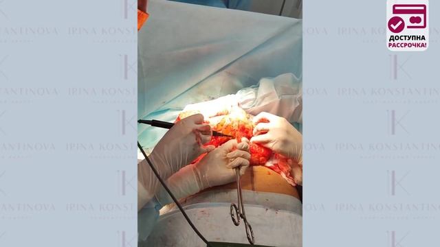 Уменьшение груди 10-го размера. Процесс уменьшения молочных желез. Съемка с операционного стола
