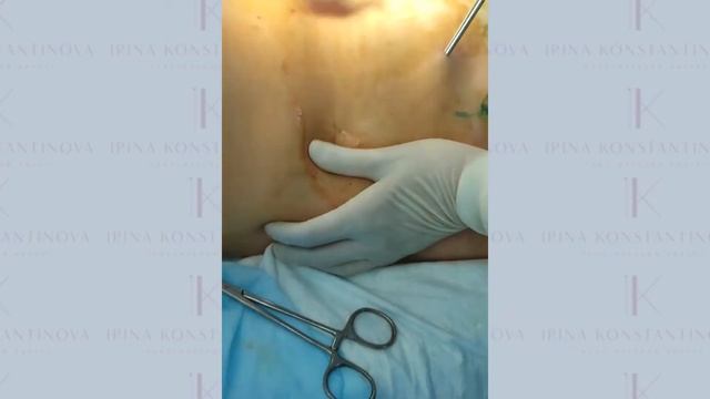 Как проводится липосакция? Съемка с операционного стола