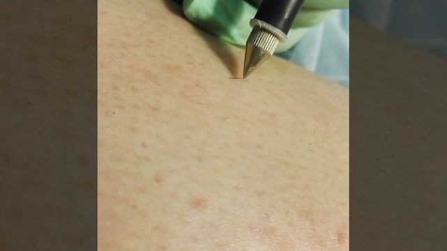 Электроэпиляция