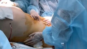 Липосакция + абдоминопластика и удаление грудных желез. Комплексная пластическая операция