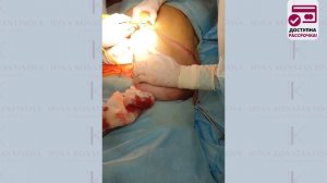 Пластика живота - классическая абдоминопластика. Хирург Константинова И.В.