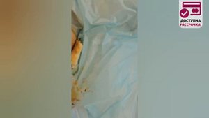 Удаление истинной гинекомастии у мужчины. Проведение операции и результат в конце видео