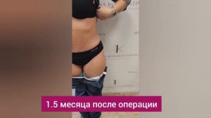 Результат абдоминопластики сразу после операции и спустя 1.5 месяца