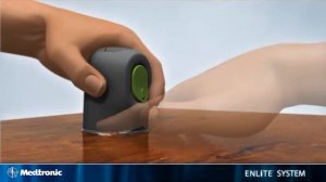 Видео инструкция по установке нового сенсора глюкозы Enlite производства Медтроник