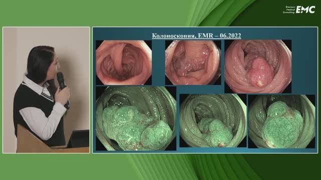 2. Николайчук Т.В., Агейкина Н.В. Гиперпластический полип больших размеров. Клинический случай.