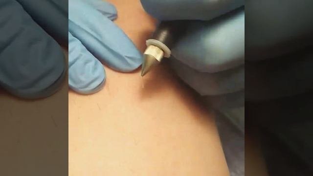 Электроэпиляция