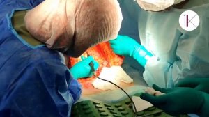 Комплексная операция: пластика груди и живота. Фрагмент проведения абдоминопластики